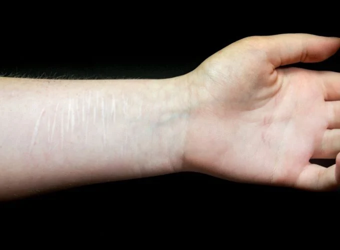 Image of arm with razor cuts - depicting self-harm